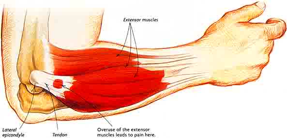 tennis elbow