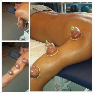 myofascial cupping at gold coast physio and sports health burliegh runaway bay massage myofascial
