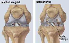 osteoarthritis class gold coast physio