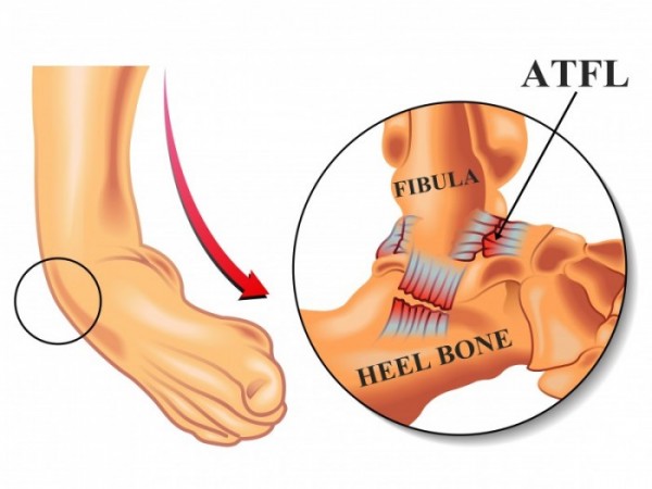 gold coast physio ankle sprain