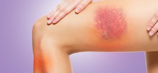 muscle contusion gold coast sports physio