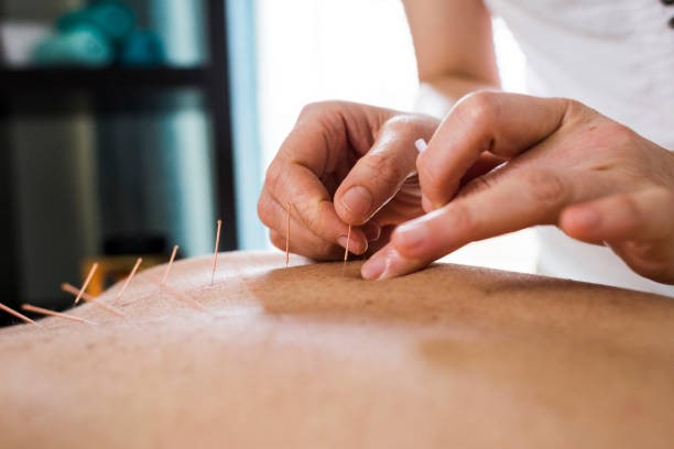 Dry Needling